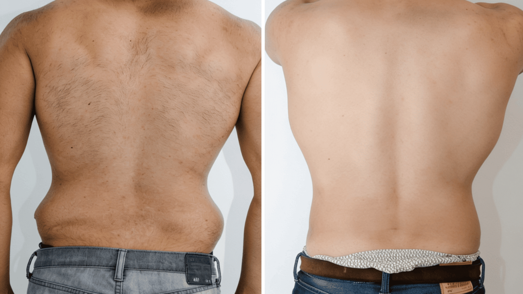 Side-by-side comparison photos showing the before and after results of back liposuction and laser hair removal on a male back.